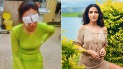 कॉर्निया में इंफेक्शन के बाद जैस्मीन की आंखों से उतरी पट्टी, बताया अब कैसी है हालत