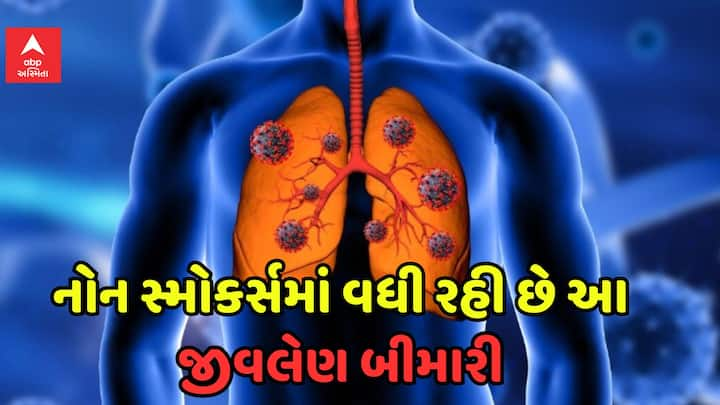 Lung Cancer Factors:  જો તમે બીડી, સિગરેટ નથી પીતા તો પણ તમે જીવલેણ ફેફસાના કેન્સરની ઝપેટમાં આવી શકો છે. નોન સ્મોકર્સમાં લંગ કેન્સરના કયા કારણ છે, આવો જાણીએ.