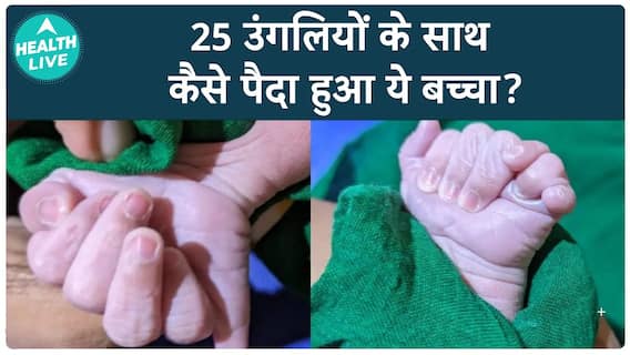 This Baby Was Born With 25 Fingers | Health Live