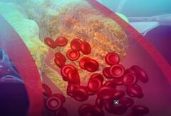 ਹਾਈ ਕੋਲੈਸਟ੍ਰੋਲ ਹੋਣ 'ਤੇ ਸਰੀਰ 'ਚ ਨਜ਼ਰ ਆਉਂਦੇ ਆਹ ਲੱਛਣ, ਤੁਰੰਤ ਅਪਣਾਓ ਆਹ ਤਰੀਕਾ, ਮਿਲੇਗਾ ਆਰਾਮ