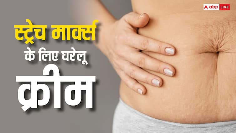 homemade cream for stretch marks use it like this skin care tips Skin Care Tips: स्ट्रेच मार्क्स से मिल जाएगा हमेशा के लिए छुटकारा, घर पर बनी इस क्रीम का करें इस्तेमाल