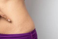 Skin Care Tips: સ્ટ્રેચ માર્ક્સથી મળશે કાયમ માટે છૂટકારો, ઘરે બનેલી આ ક્રીમનો કરો ઉપયોગ