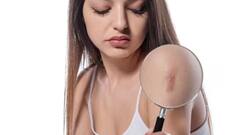 Body Scars: সরাজীবন শরীরে থেকে যায় ক্ষতের দাগ, কারণ জানেন?