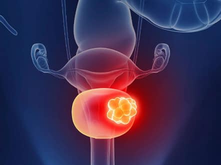 Patients suffering from bladder cancer have severe pain in their hands and feet. Mainly during this time they feel very tired, due to which they may feel pain in their hands and feet. Avoid ignoring such a condition. It can be very serious.