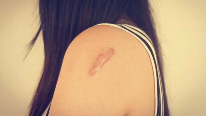 বাইরের এই আবরণই ত্বককে রক্ষা করে। এই Epidermis-এর নীচের স্তর হল Dermis. ধমনী, রক্তনালি, অয়েল গ্ল্যান্ড, হেয়ার ফলিকল নিয়ে গঠিত পুরু এই আস্তরণ। এর মধ্যেই কোলাজেন। থাকে, যা টানটান রাখে ত্বককে।