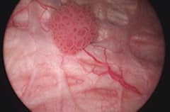 Bladder Cancer: ਇਨ੍ਹਾਂ 4 ਹਿੱਸਿਆਂ 'ਚ ਹੁੰਦਾ ਦਰਦ, ਤਾਂ ਸਮਝ ਜਾਓ ਆਖਰੀ ਸਟੇਜ 'ਤੇ ਪਹੁੰਚ ਗਿਆ ਬਲੈਡਰ ਕੈਂਸਰ