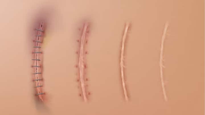 এই Dermis-এর নীচের আস্তরণে বলা হয় Hypodermis, যা আঘাত থেকে ভিতরের অংশকে রক্ষা করে। শুধুমাত্র Epidermis ক্ষতিগ্রস্ত হলে পুরনো চামড়া উঠে আবার ঠিক হয়ে যায়।