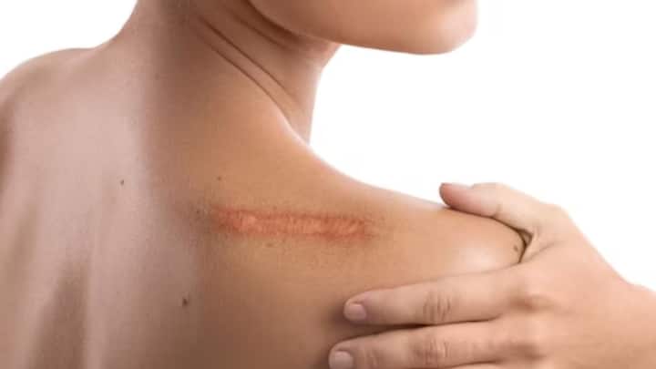 সাধারণ ছড়ে-কেটে যাওয়া যদিও বা মিলিয়ে যায়, ক্ষত গভীর হলে দাগ থেকে যায় শরীরে। অস্ত্রোপচরারের দাগও থেকে যায় সারাজীবন। শরীরে দাগ রয়ে যাওয়ার নেপথ্যে রয়েছে বৈজ্ঞানিক কার্যকারণ।