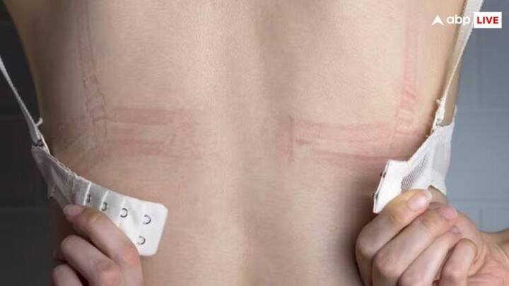 જે મહિલાઓ ચુસ્ત બ્રા પહેરે છે તેમને ઘણી સમસ્યાઓનો સામનો કરવો પડે છે નિષ્ણાતોના મતે વધુ પડતી ટાઈટ બ્રા પહેરવાથી ઘણી ગંભીર બીમારીઓ થઈ શકે છે.