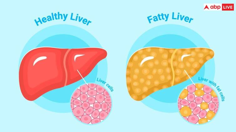 Fatty liver disease is a condition in which fat builds up in your liver Fatty Liver: फैटी लिवर होने के बाद भूलकर भी नहीं करें ये गलती, हो सकता है बड़ा नुकसान