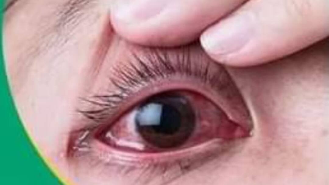 Kota Conjunctivitis or Eye flu risk increases during monsoon know Symptoms and precaution ANN Conjunctivitis: बरसात के मौसम में बढ़ जाता है आई फ्लू का खतरा, जानिए लक्षण और बचाव के उपाय