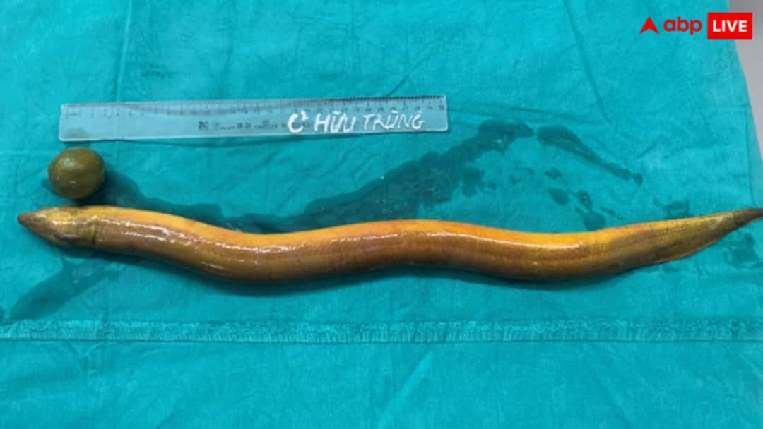 Live eel fish found in man body and ate his intestines शख्स के पेट से निकली जिंदा मछली, आंतों का कर दिया ऐसा हाल, देखकर कांप जाएगी रूह