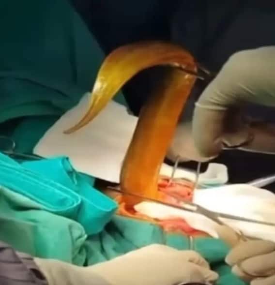 ਮਰੀਜ਼ ਦੇ ਪ੍ਰਾਈਵੇਟ ਪਾਰਟ 'ਚੋਂ ਨਿਕਲਿਆ ਇਹ ਜੀਵ, ਡਾਕਟਰਾਂ ਦੇ ਉਡੇ ਹੋਸ਼