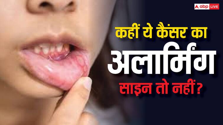 health tips mouth sores may symptoms of cancer know treatment Mouth Sores: मुंह में लंबे समय तक घाव रहना कैंसर का है लक्षण? जानें क्या है सच