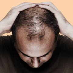 ਮਰਦਾਂ ਦੇ ਗੰਜੇਪਨ ਦਾ ਇਹ ਹੈ ਮੁੱਖ ਕਾਰਨ,  ਸੁਣ ਕੇ ਹੋ ਜਾਓਗੇ ਹੈਰਾਨ