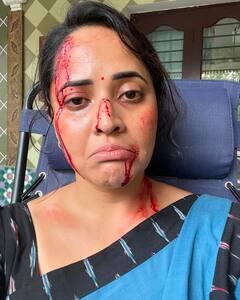 Anasuya Bharadwaj: అనసూయ ముఖమంతా రక్తం, అసలేం జరిగిందంటే - వైరల్ ఫోటోస్ వెనుక కహాని