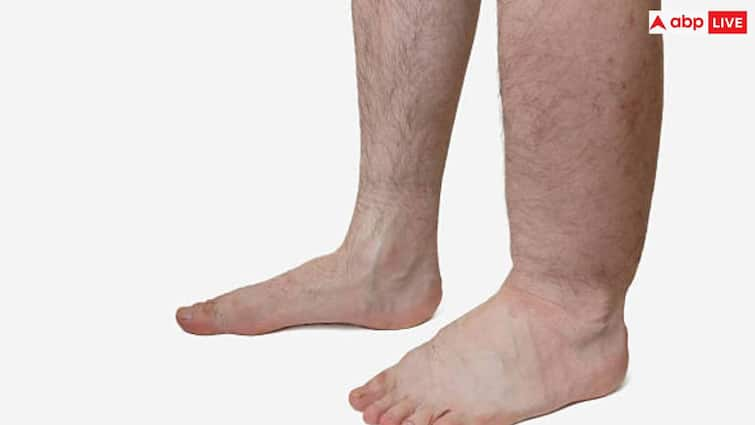 What is the cause of lymphatic filariasis in india read full article in hindi क्या होता है लिम्फेटिक फिलेरियासिस, जिसे लेकर मोदी सरकार ने शुरू किया बड़ा अभियान