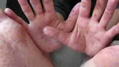 Monkey Pox: दुनियाभर में फैल रही ये बीमारी, हाई रिस्क पर हैं अफ्रीका के 34 देश; WHO ने दे दी चेतावनी