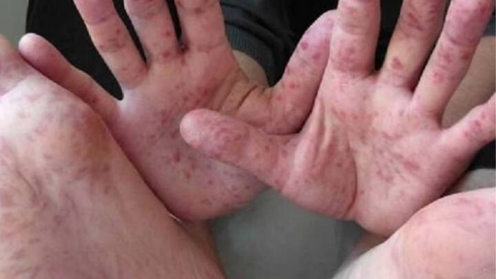 अफ्रीका में एम पॉक्स तेजी से फैल रहा है. एम पॉक्स यानी कि मंकीपॉक्स और यह वायरस दुनिया के लिए खतरा बन सकता है. वर्ल्ड हेल्थ ऑर्गेनाइजेशन के महानिदेशक ट्रेडोस एडनॉम गेब्रेसस ने इसे लेकर विनियमन आपातकालीन समिति की बैठक रखी है.