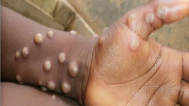 मंकी पॉक्स के लक्षण जल्दी नहीं दिखते हैं. यदि कोई व्यक्ति मंकी पॉक्स से संक्रमित है तो 1 से 2 हफ्ते बाद ही उसे इसके लक्षण दिखेंगे. इसमें बुखार, सिर दर्द, मांसपेशियों में दर्द, शरीर पर दाने निकल जाना, थकान और पीठ दर्द शामिल है.