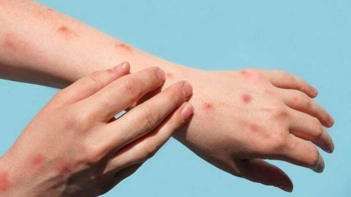 वर्ल्ड हेल्थ आर्गेनाईजेशन के एम मंकीपॉक्स पर्यवेक्षक रोजामुंड लुईस ने बताया कि उन्हें नहीं पता था कि यह ज्यादा संक्रामक है और काफी तेजी से फैल रहा है.