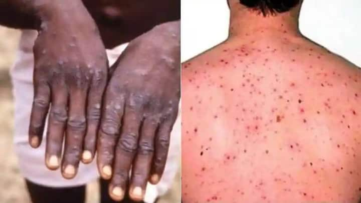 Monkey Pox: अफ्रीका में एम पॉक्स तेजी से फैल रहा है. एम पॉक्स यानी कि मंकीपॉक्स और यह वायरस दुनिया के लिए खतरा बन सकता है. मंकी पॉक्स शुरुआत में डेमोक्रेटिक रिपब्लिक ऑफ कांगो में डिटेक्ट हुआ था.