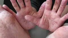 વિશ્વભરમાં આ રોગે હાહાકાર મચાવ્યો, 34 દેશોમાં છે સૌથી વધુ જોખમ; WHOએ આપી ચેતવણી