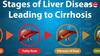 Liver Damage Signs: ਰਾਤ ਨੂੰ ਦਿੱਖ ਸਕਦੇ ਲੀਵਰ ਖਰਾਬ ਹੋਣ ਦੇ 5 ਲੱਛਣ, ਜਾਣੋ ਕਦੋਂ ਹੋਣਾ ਚਾਹੀਦਾ ਸਾਵਧਾਨ