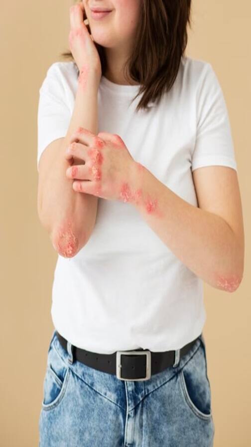 Monkeypox ਦੇ ਕੀ ਨੇ ਸ਼ੁਰੂਆਤੀ ਲੱਛਣ ?