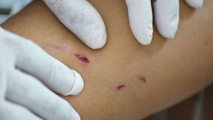 घाव को धोने के बाद तुरंत ़डाॅक्टर के पास जाकर रेबीज का इंजेक्शन लगवाएं. इससे आप पूरी तरह से रेबीज के खतरे से बच जाएंगे.