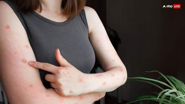 Monkeypox Spots: मंकीपॉक्स होने के बाद शरीर पर रह गए हैं दाग? ऐसे आसानी से हो जाएंगे गायब skin care tips spots left on body after monkeypox will easily disappear know process Monkeypox Spots: मंकीपॉक्स होने के बाद शरीर पर रह गए हैं दाग? ऐसे आसानी से हो जाएंगे गायब