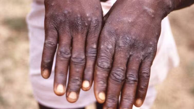 Sweden Confirms First Case Of Mpox Outside Africa Amid Global Public Health Emergency WHO Sweden Confirms First Case Of Mpox Outside Africa Amid Global Public Health Emergency