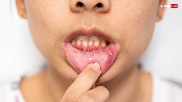 Mouth Ulcers: अगर आपके मुंह में भी छाले होने लगे हैं और इससे आप खाना पीना ठीक से नहीं कर पा रहे हैं, तो इन सभी टिप्स को फॉलो कर छालों से छुटकारा पा सकते हैं.