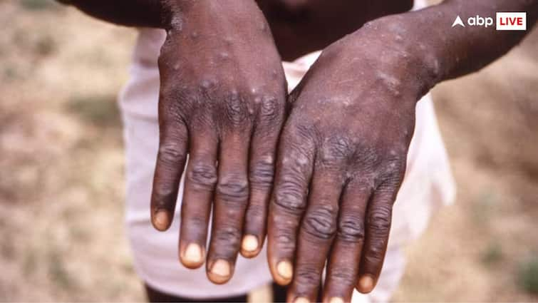 thailand confirms first asia mpox case new strain monkeypox danger india સાવધાન! એશિયા સુધી પહોંચ્યો મંકીપોક્સનો પ્રથમ કેસ, આ દેશોમાં ફેલાઈ રહ્યો છે; ભારત માટે કેટલું મોટું જોખમ