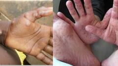 Monkeypox: कोरोना की तरह महामारी बनता जा रहा मंकीपॉक्स, अफ्रीका के बाहर भी मिल रहे मरीज; 100 से ज्यादा लोगों की हुई मौत