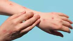 આફ્રિકા બહાર ફેલાવા લાગ્યો Mpox, સ્વીડનમાં નોંધાયો પ્રથમ કેસ, UNએ વ્યક્ત કરી ચિંતા