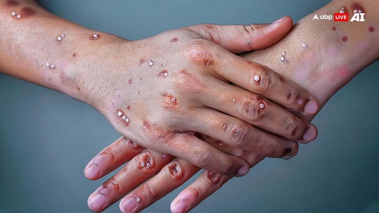 monkeypox symptoms rash Do not do these things even by mistake if you have monkeypox Monkey Pox: मंकीपॉक्स होने पर भूलकर भी न करें ये चीजें, जिंदगीभर होगा पछतावा साथ ही जानें कैसे दिखते हैं इसके दाने