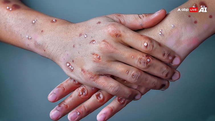 WHO declared that an outbreak of mpox how worried should you be 10 points MonkeyPox: तेजी से बढ़ रहे हैं मंकीपॉक्स के मामले, जानें क्यों इस बीमारी से डरना चाहिए?