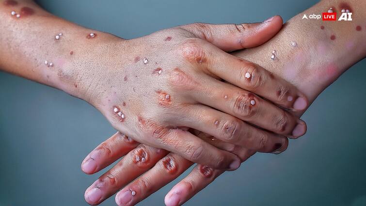 MonkeyPox: तेजी से बढ़ रहे हैं मंकीपॉक्स के मामले, जानें क्यों इस बीमारी से डरना चाहिए? WHO declared that an outbreak of mpox how worried should you be 10 points MonkeyPox: तेजी से बढ़ रहे हैं मंकीपॉक्स के मामले, जानें क्यों इस बीमारी से डरना चाहिए?