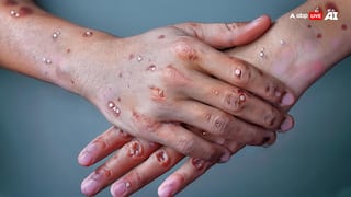 MonkeyPox: तेजी से बढ़ रहे हैं मंकीपॉक्स के मामले, जानें क्यों इस बीमारी से डरना चाहिए?