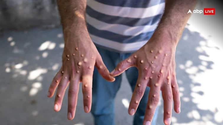 monkeypox enters india suspected mpox case under investigation ભારતમાં પણ મંકીપોક્સની એન્ટ્રી! વિદેશથી પરત આવેલા વ્યક્તિમાં લક્ષણો મળ્યા, આઈસોલેટ કરવામાં આવ્યો