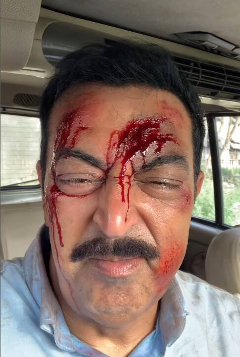 ਦਰਅਸਲ, ਵਿੰਦੂ ਦਾਰਾ ਸਿੰਘ ਵੱਲੋਂ ਸ਼ੇਅਰ ਕੀਤੇ ਗਏ ਇਸ ਵੀਡੀਓ ਵਿੱਚ ਅਦਾਕਾਰ ਖੂਨ ਨਾਲ ਲਥਪਥ ਨਜ਼ਰ ਆ ਰਿਹਾ ਹੈ। ਉਨ੍ਹਾਂ ਦਾ ਲਹੂ-ਲੁਹਾਣ ਚਿਹਰਾ ਵੇਖ ਪ੍ਰਸ਼ੰਸਕ ਵੀ ਚਿੰਤਾ ਵਿੱਚ ਪੈ ਗਏ ਹਨ।