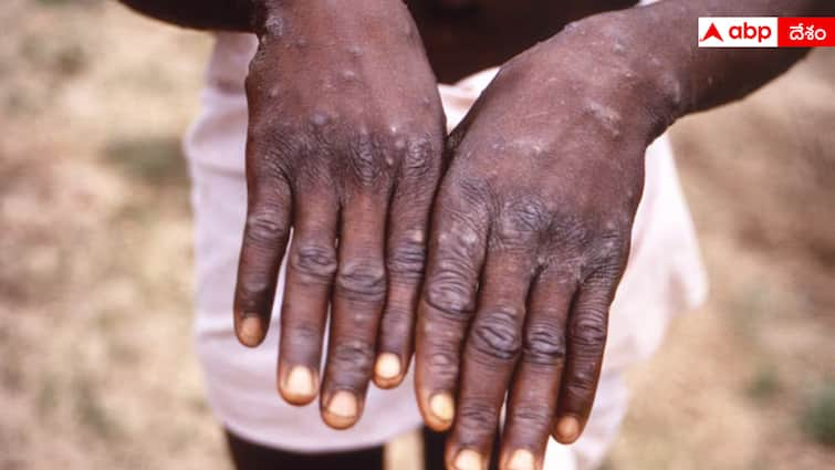 how many deaths caused by monkeypox global toll update મંકીપોક્સથી અત્યાર સુધીમાં કેટલા લોકોનાં મોત થયાં છે? જાણો આ કેટલું ખતરનાક છે