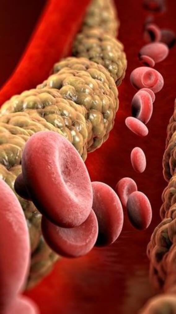 హై కొలెస్ట్రాల్​ని ఇలా సింపుల్ టిప్స్​తో తగ్గించుకోండి