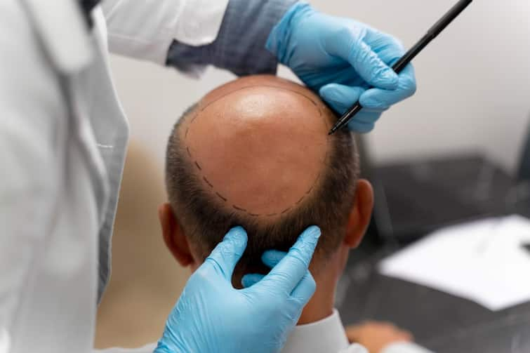 treatment hair loss does hair grow back science explains શું વાળ ખરેખર પાછા ઉગે છે? જાણો વિજ્ઞાન શું કહે છે