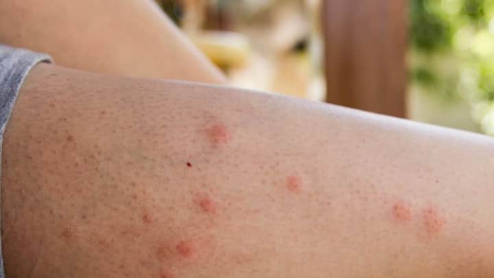 3. West Nile virus: It is spread by Culex mosquitoes and can cause symptoms ranging from mild flu-like illness to severe neurological conditions. In some cases, it can lead to encephalitis or meningitis. (Image Source: Pinterest/ruleyourownworld_)