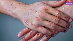 દુનિયાભરમાં મંકીપૉક્સનો ડર, કેટલી ખતરનાક છે આ બીમારી, ભારત પર શું છે ખતરો?