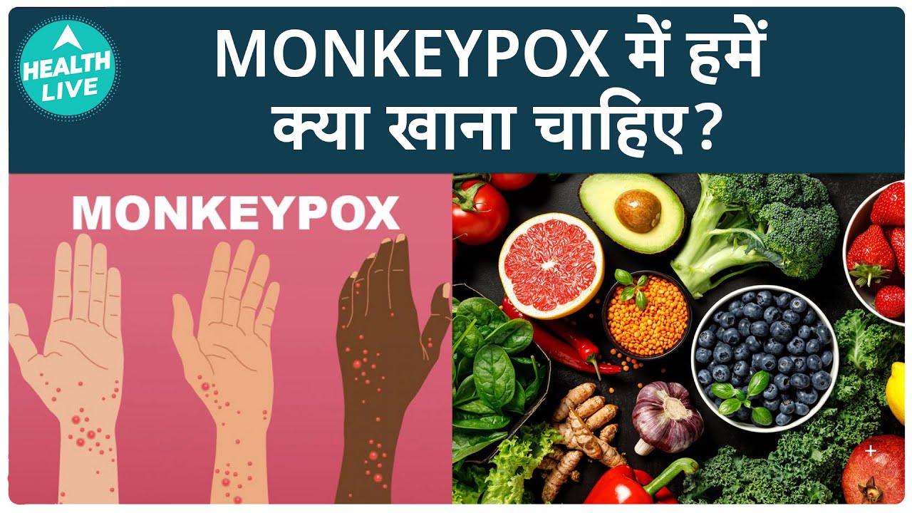 What Should You Eat In Monkeypox Situation | Health Live