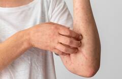 Monkeypox: મંકીપૉક્સથી ડરવાની કેટલી જરૂર, શું આ બીમારીથી થઇ શકે છે મોત?