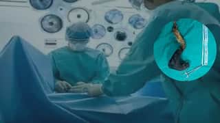 तुमचं मुलं केस खातं? वेळीच लक्ष द्या, मुंबईत 10 वर्षीच्या मुलीच्या पोटातून काढला 50 सेमी लांबीचा केसांचा गुंता